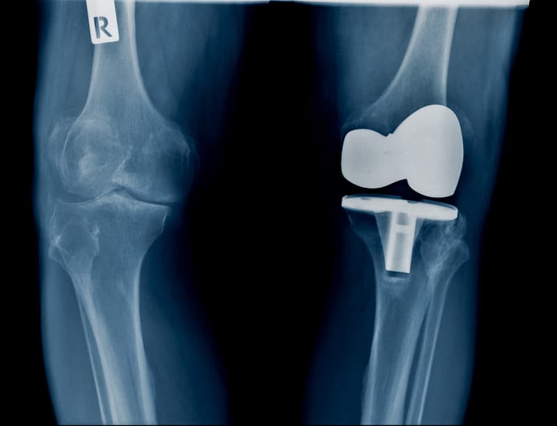 Hight Quality X Ray With Knee Joint Replacement