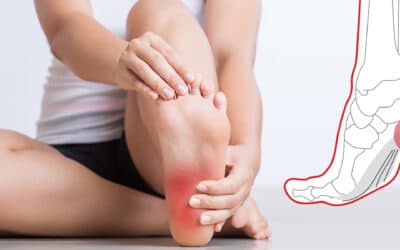 Everything You Need to Know About Plantar Fasciitis